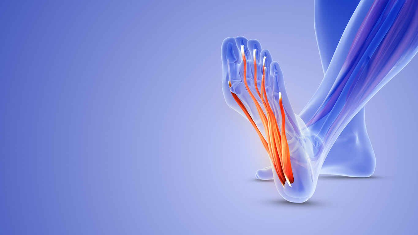 Plantar Fasciitis